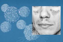 CAR-T cells on a blue background and a black-and-white photo of a man's face with characteristic lupus rash