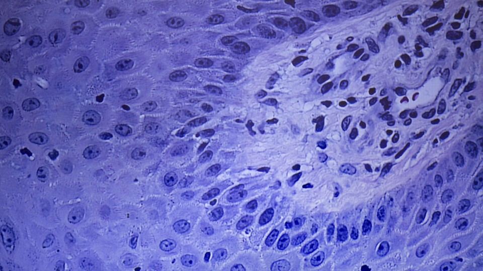 A microscopic image of a skin biopsy, stained purple