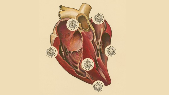 A drawing of a human heart with coronaviruses surrounding it