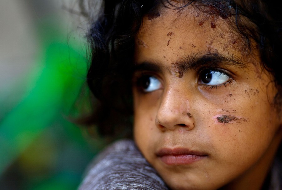 A close photograph of a girl with several scrapes and scabs visible on her face