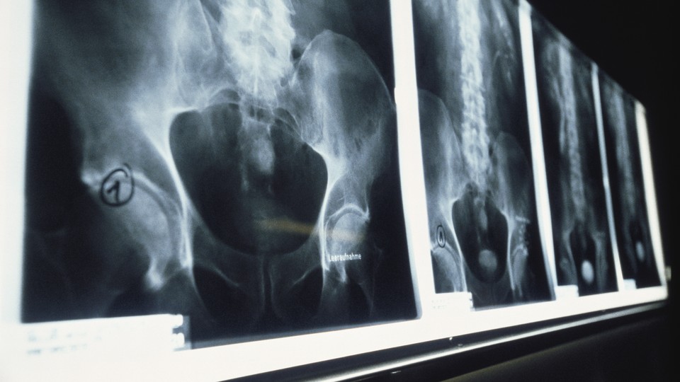 X-rays of the hip and lower back lined up on the wall
