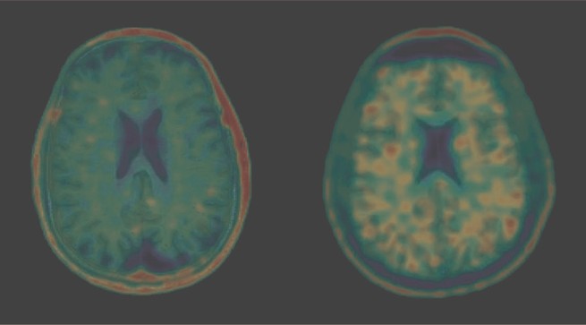 Axial images of T1-weighted MRI overlaid with [18F]AV-1451/T807 PET in a healthy control (left) and in a National Football League (NFL) player with a history of 22 concussions and clinically probable chronic traumatic encephalopathy (CTE; right)