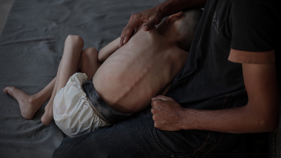 A 6-year-old is affected by severe food shortages in western Gaza on July 27, 2025.