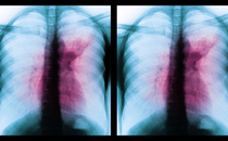 two side-by-side colored x-rays of lungs with opacity in the middle, indicating TB infection