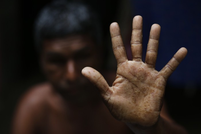 A man displays his hands with spots from arsenic poisoning.