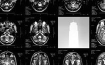 A series of brain scans interrupted by an image of a drug-injection pen