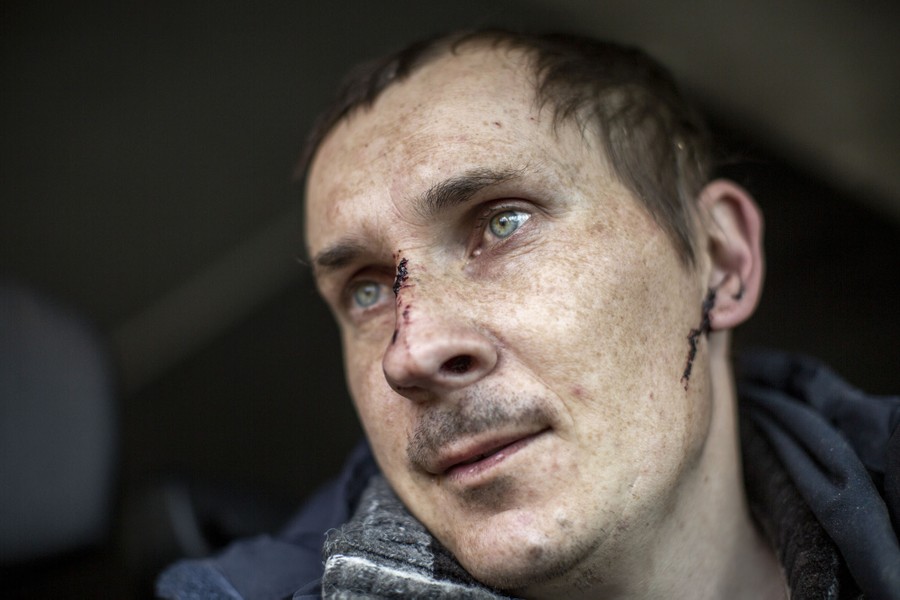 A close view of a man's face, showing blood on the bridge of his nose and below his ear