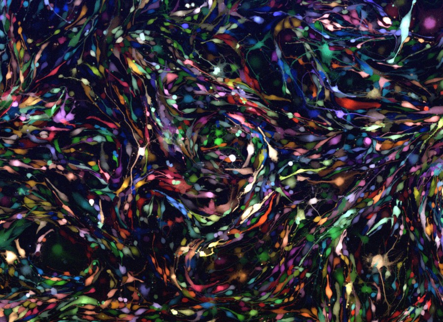 Close view of brain-tumor cells