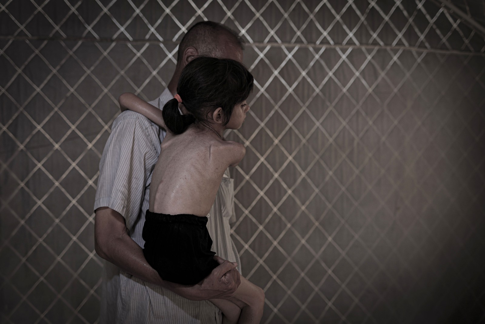 A man holds a severely undernourished child in his arms.