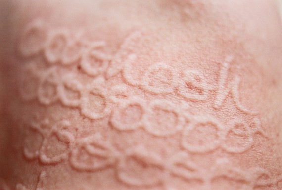 Hives / Urticaria — The Tic-Tac-Toe that we can create on our skin