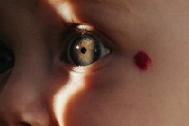 A photo of a baby with fair skin, green eyes, and a red mark next to their left eye. A line of sunlight cuts vertically through their face and left eye.
