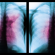 two side-by-side colored x-rays of lungs with opacity in the middle, indicating TB infection