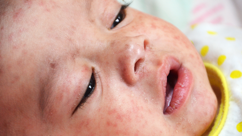 A baby with the measles rash