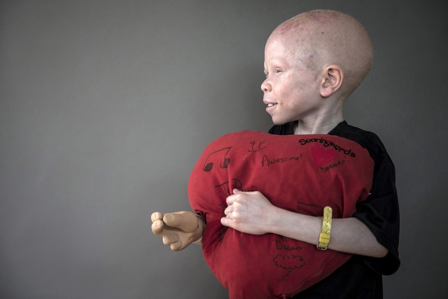 Albino Children in Tanzania Targeted by Body Part Hunters - The Atlantic