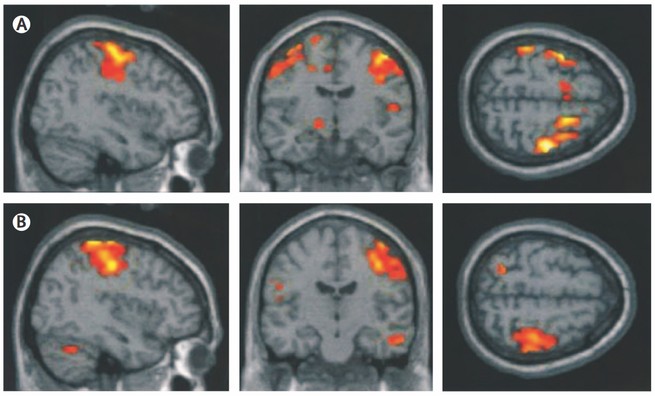The Toxins That Threaten Our Brains The Atlantic
