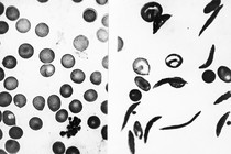 an image of blood cells in normal state (left) and with sickle cell disease (right)