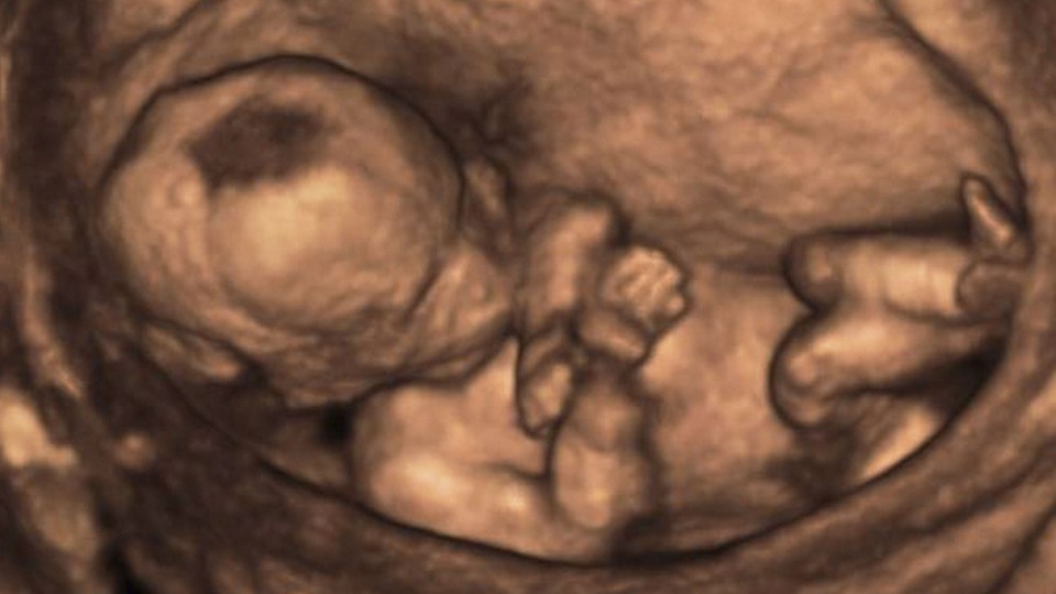 A 3d ultrasound image of a fetus inside a womb