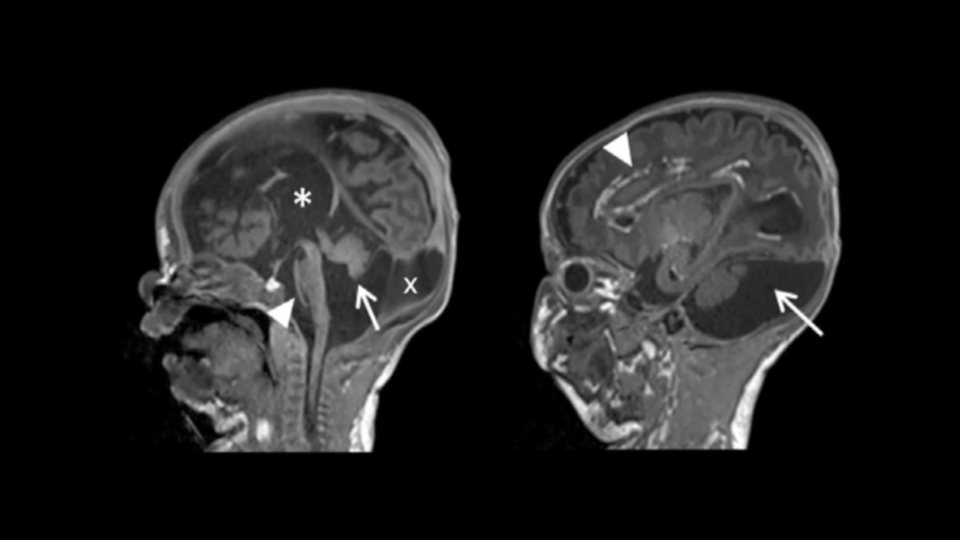 MRIs of the boy's brain