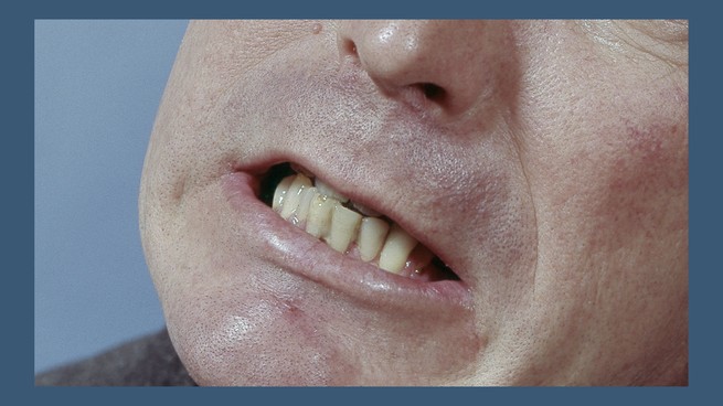 An image of a man clenching his teeth