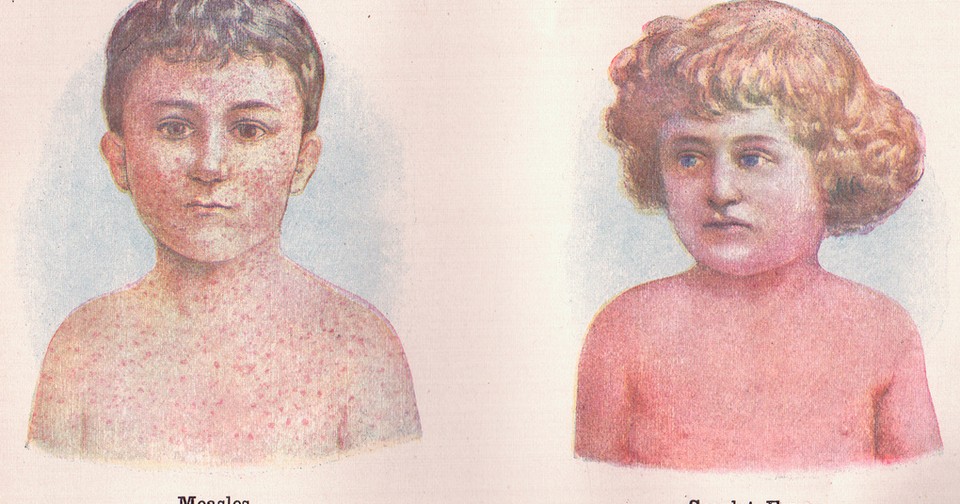 NextImg:The New Measles