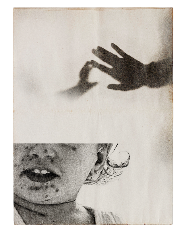 A collage showing a young child with measles and the shadow of two hands