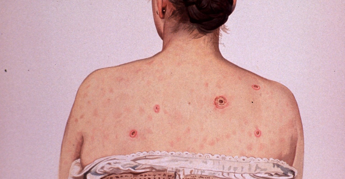 can you get gonorrhea from sharing cigarettes Gonorrhea - Womens Health Specialists