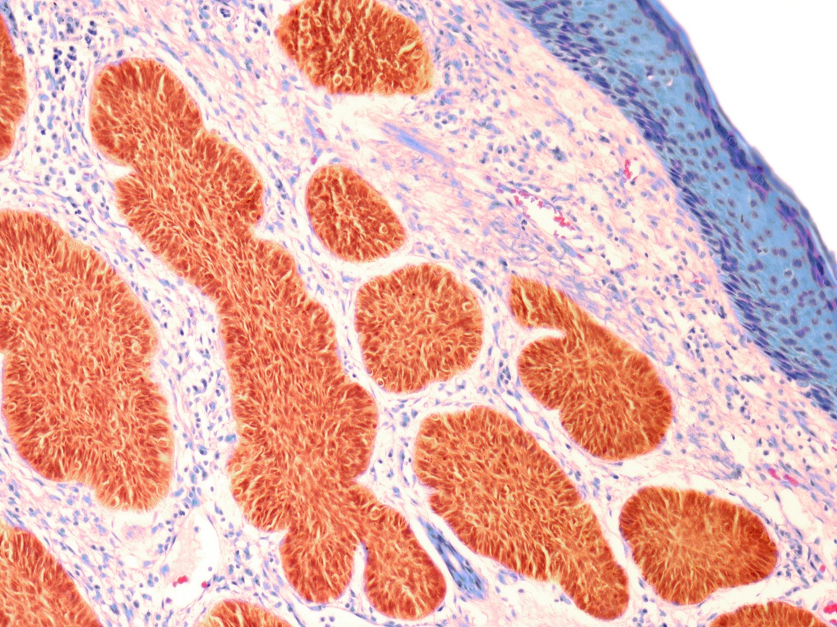 Ai Driven Dermatology Could Leave Dark Skinned Patients Behind The Atlantic