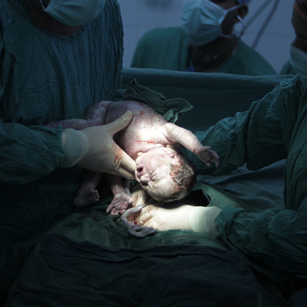 What is a C-section?