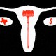 An illustration of a white uterus with a red gavel inside, and white fallopian tubes, with a red state of Texas in the left ovary and a red dollar sign in the right ovary