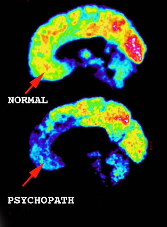 psychopath brain