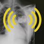 An X-ray of a chest showing a pacemaker overlaid with yellow Wi-Fi-style lines emanating from the pacemaker