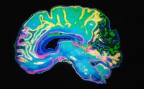 An artificially colored MRI scan of the human brain