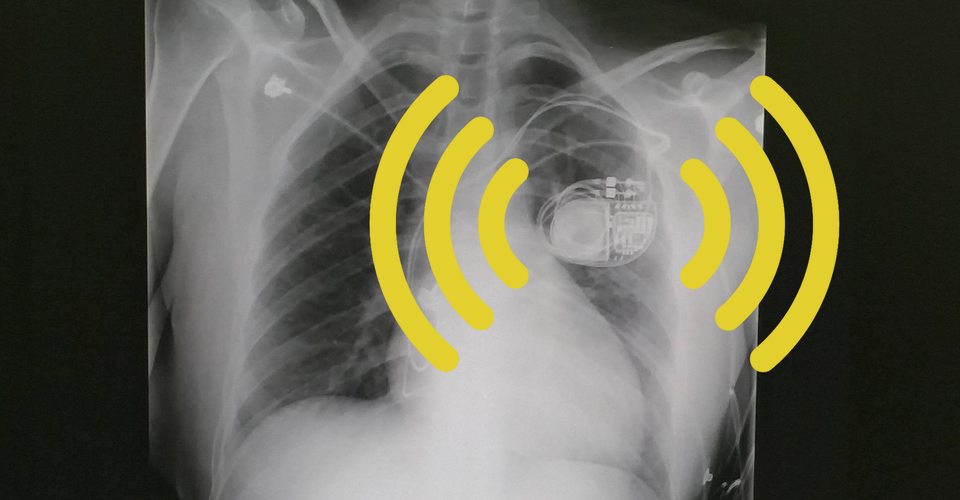 My Pacemaker Is Tracking Me From Inside My Body The Atlantic