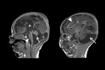 MRIs of the boy's brain